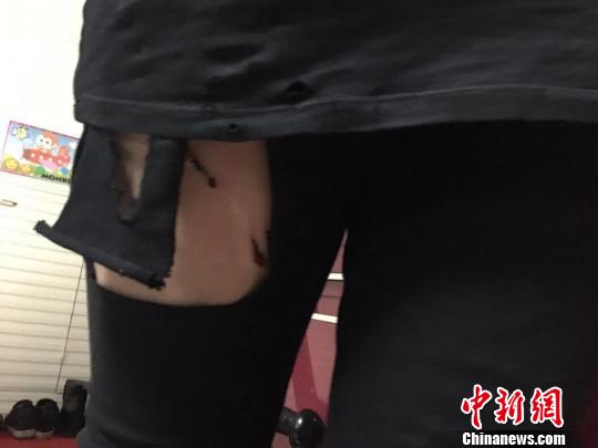 小雅(化名)大腿被狗咬伤，裤子破损严重。　受访者供图摄