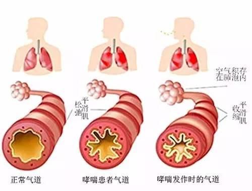 灰尘过敏哮喘_过敏哮喘养狗_中国过敏与哮喘