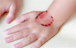 狂犬病毒感染后没法治疗，一旦被咬必须疫苗注射，侥幸心理害死人